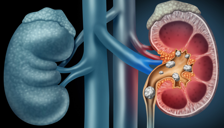 10 Effective Home Remedies To Treat Kidney Stones