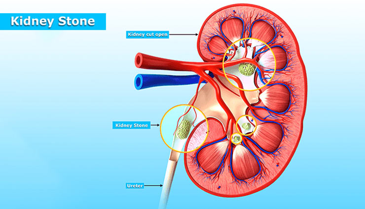kidney stones,ways to avoid kidney stones,kidney care tips,Health tips,fitness tips