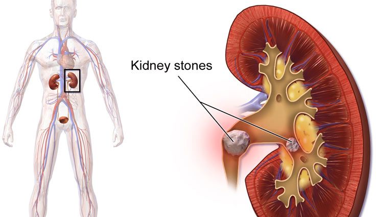 किडनी स्टोन के दर्द में राहत पाने के लिए आजमाए ये नुस्खे, मिलेगा जल्द आराम 