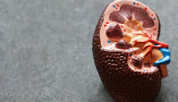 5 Ways To Avoid Kidney Stones