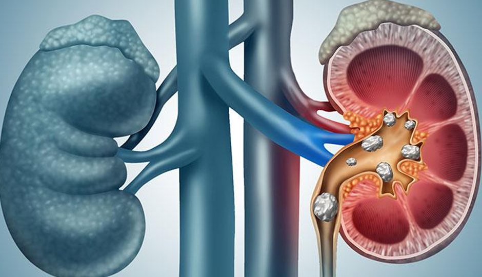 7 Surprising Facts About Kidney Stones You Should Know