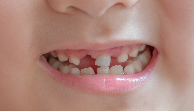 6 Foods That Will Ruin Your Kids Teeth