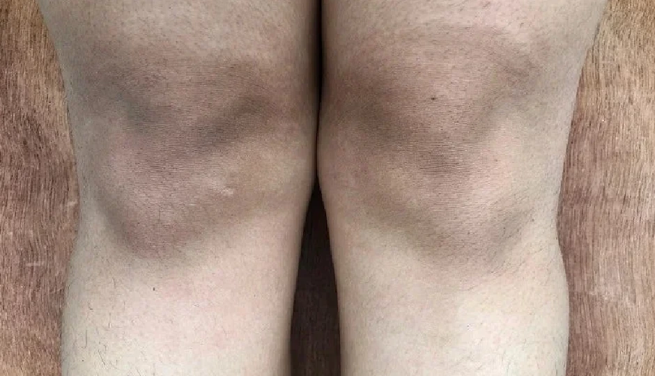 घुटनों के कालेपन को छुपाने की बजाय जड़ से मिटाएं! अपनाएं ये आसान और प्रभावी उपाय