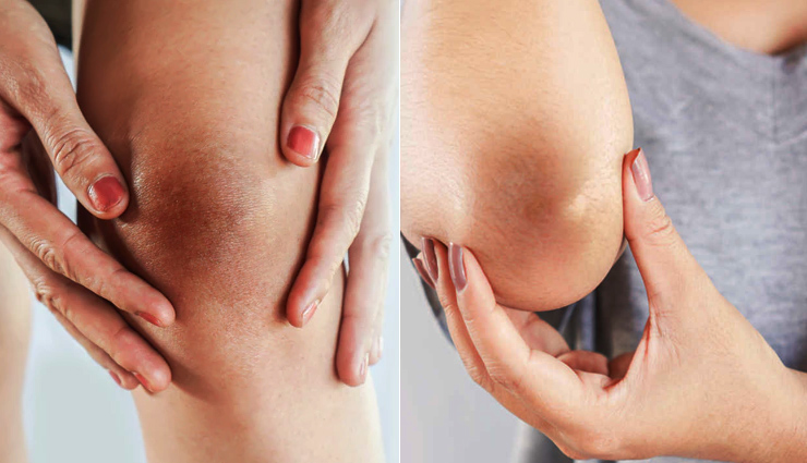 गर्दन, कोहनी और घुटने का कालापन आपकी सुंदरता को करता है कम, दूर करने के लिए काम आएंगे ये टिप्स