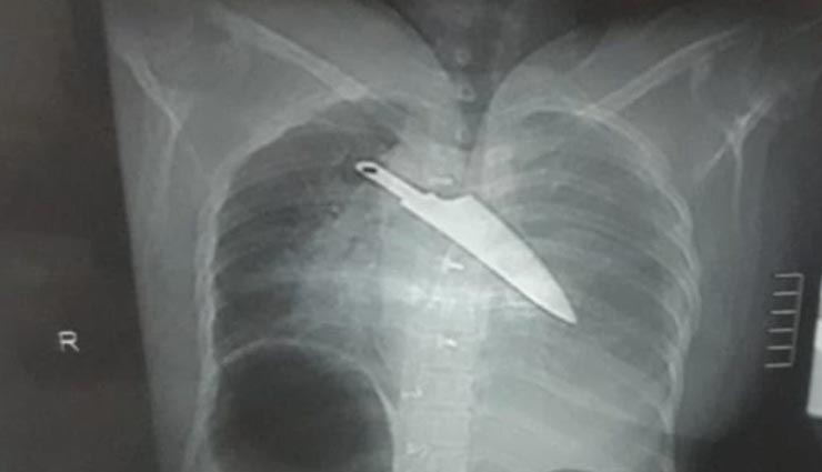 चमत्कार! 30 घंटे तक सीने में चाकू घुसे रहने के बाद भी बच गई महिला की जान