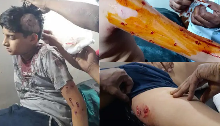 राजस्थान: कोटा में कुत्तों ने 12 साल के बच्चे को 40 जगह काटा, लगे 12 टांके 