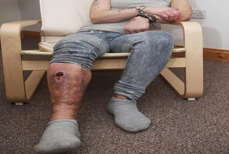 krokodil drug,krokodil drug ingredients,desomorphine,heroine,worlds deadliest drug,britain,krokodil,drug,weird story hindi