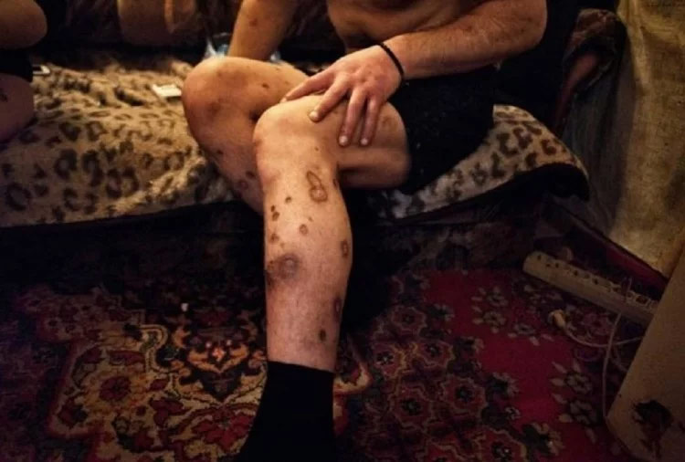 krokodil drug,krokodil drug ingredients,desomorphine,heroine,worlds deadliest drug,britain,krokodil,drug,weird story hindi