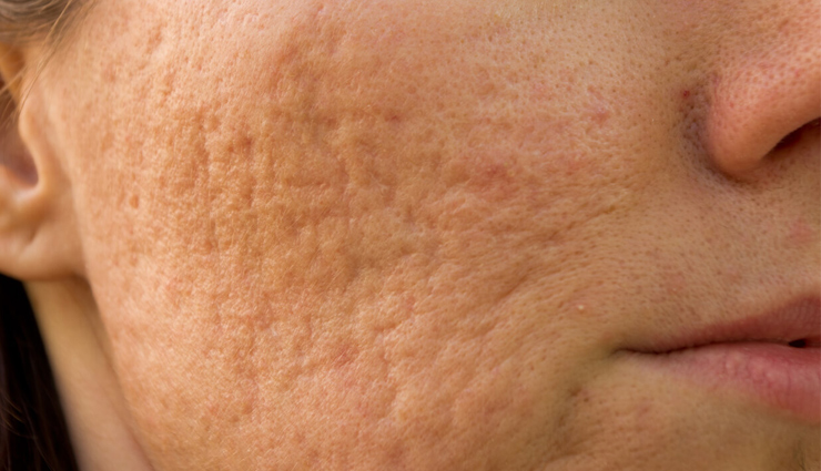 10 DIY Ways That are Helpful in Shrinking Large Pores