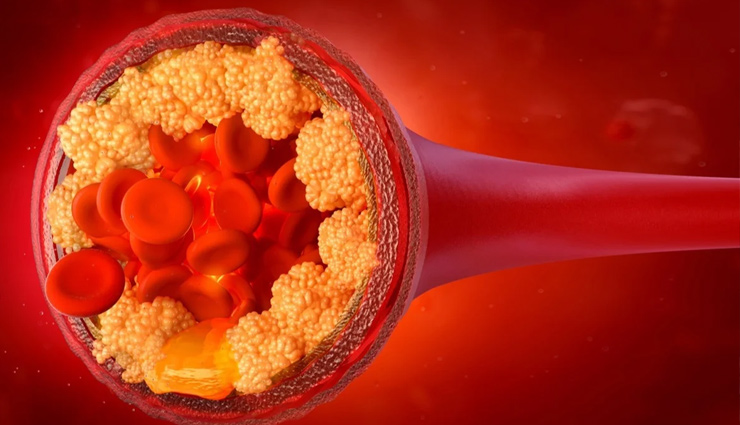 cholesterol,high cholesterol,saturated fat,saturated fat food list,heart problem,Health,healthy living