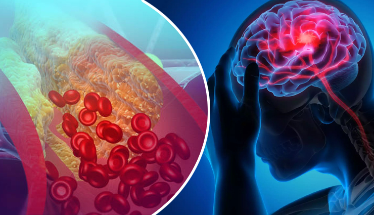 गंदा LDL कोलेस्ट्रॉल भी जरूरी बॉडी के लिए, इसके लो लेवल से आ सकता है स्ट्रोक, इन संकेतों पर रखे नजर