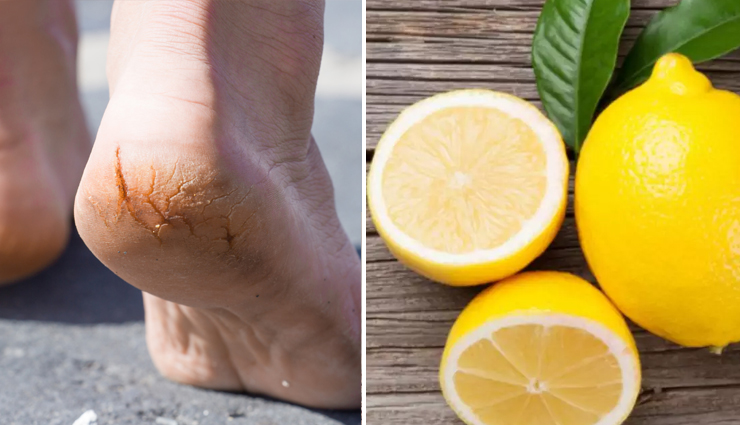treat cracked heels at home,cracked heels,cracked heels remedies,feet,beauty,beauty tips
