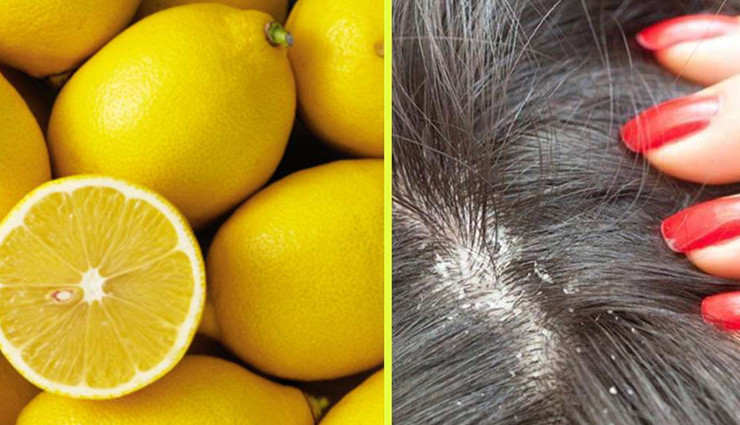 dandruff treatment,home remedies dandruff,scalp,dandruff treatment,dandruff funguss,beauty,beauty tips