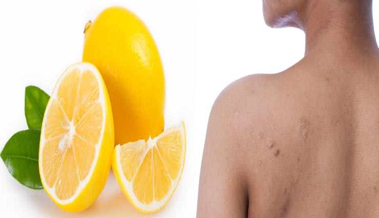 beauty tips,beauty tips in hindi,remove acne from back,home remedies,skin care tips