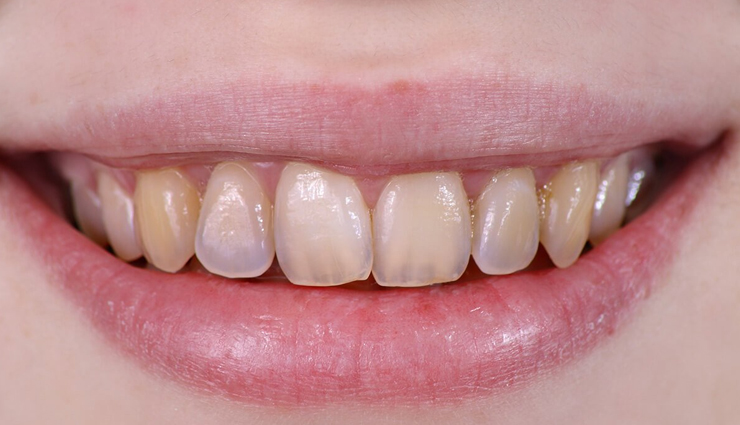 lemons,side effects of consuming lemons,Health tips,fitness tips