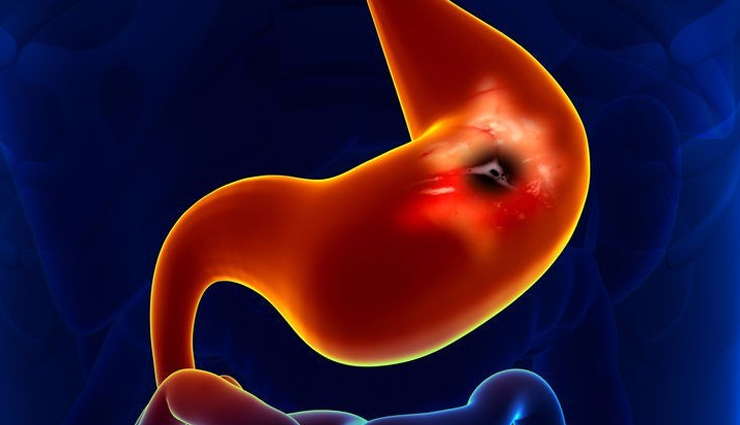 lemons,side effects of consuming lemons,Health tips,fitness tips