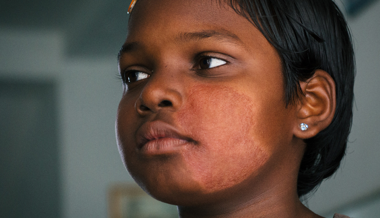 8 Remedies To Treat Leprosy at Home