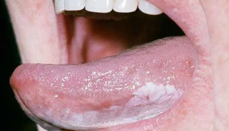 common mouth problems,tongue issues,dental hygiene,oral health concerns,mouth and tongue conditions,dental caries prevention,periodontal disease prevention,amalgam tattoo,halitosis treatment,black hairy tongue causes,canker sore remedies,tooth decay prevention,tooth abscess treatment,cold sore management,chipped tooth repair,leukoplakia diagnosis,lichen planus symptoms,thrush treatment,oral cancer detection,dry mouth remedies