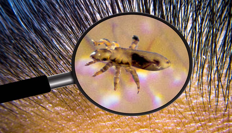 सिर को दिलाए जुओं से छुटकारा, आजमाए ये बेहतरीन नुस्खें