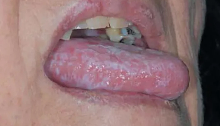 common mouth problems,tongue issues,dental hygiene,oral health concerns,mouth and tongue conditions,dental caries prevention,periodontal disease prevention,amalgam tattoo,halitosis treatment,black hairy tongue causes,canker sore remedies,tooth decay prevention,tooth abscess treatment,cold sore management,chipped tooth repair,leukoplakia diagnosis,lichen planus symptoms,thrush treatment,oral cancer detection,dry mouth remedies