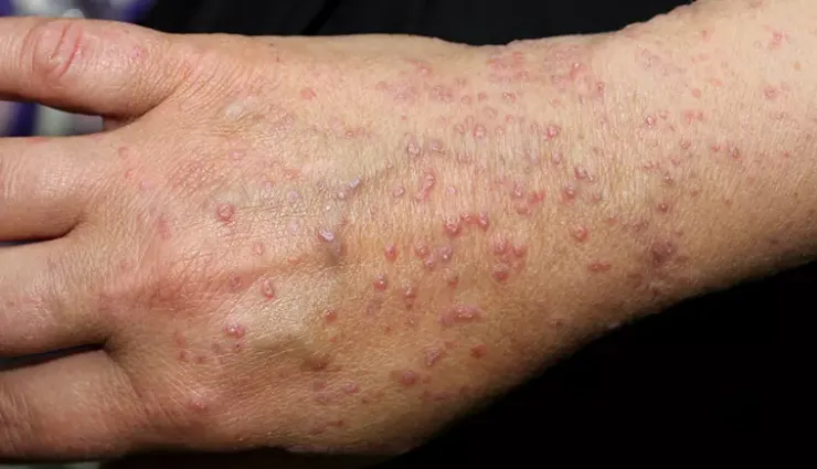 most common causes of lichen planus,beauty tips,beauty hacks