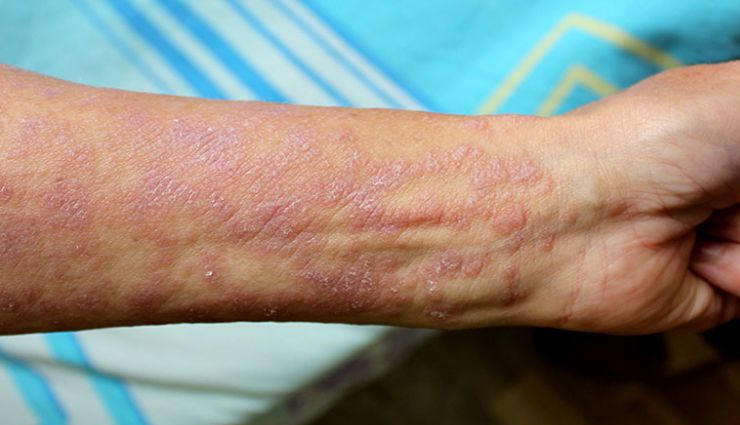 most common causes of lichen planus,beauty tips,beauty hacks