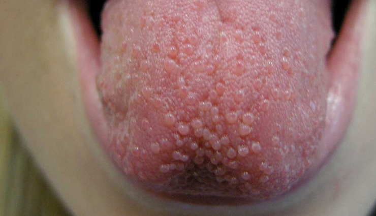 common mouth problems,tongue issues,dental hygiene,oral health concerns,mouth and tongue conditions,dental caries prevention,periodontal disease prevention,amalgam tattoo,halitosis treatment,black hairy tongue causes,canker sore remedies,tooth decay prevention,tooth abscess treatment,cold sore management,chipped tooth repair,leukoplakia diagnosis,lichen planus symptoms,thrush treatment,oral cancer detection,dry mouth remedies