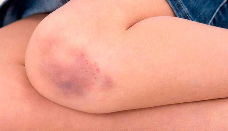 15 Home Remedies To Lighten Bruises