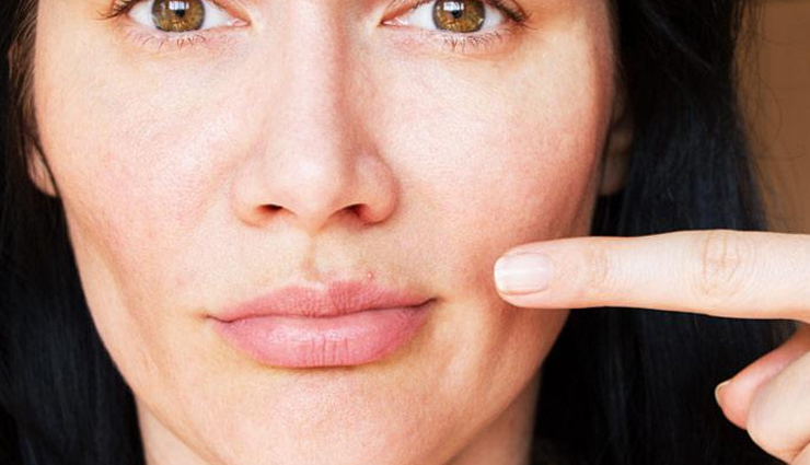 6 Home Remedies You Can Try To Get Rid of Lip Pimple