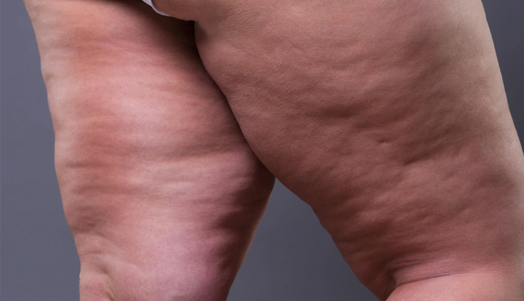 lipedema diet benefits,health advantages of lipedema diet,lipedema nutrition benefits,lipedema management through diet,benefits of a healthy lipedema diet,nutrition for lipedema patients,lipedema and dietary wellness,balanced diet for managing lipedema,lipedema dietary solutions,nutrition and health benefits in lipedema