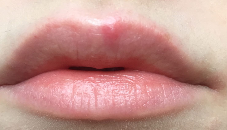 फटे होंठ कर रहे हैं चेहरे की ख़ूबसूरती को कम, ले इन घरेलू नुस्खों की मदद