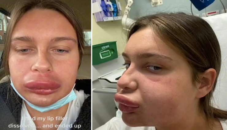 सुंदरता बढ़ाने के लिए सर्जरी करवाना महिला को पड़ा भारी, फूलकर होंठ बने गुब्बारे!