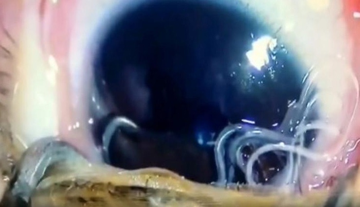china,doctor,insects,eye,live worms from eyes,omg news,weird news