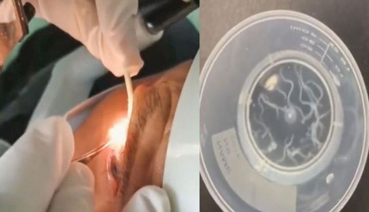 china,doctor,insects,eye,live worms from eyes,omg news,weird news