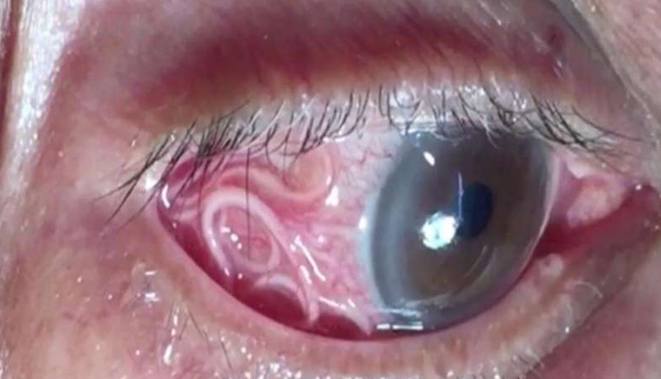 OMG:  डॉक्टरों ने एक शख्स की आंख से निकाले 20 जिंदा कीड़े  