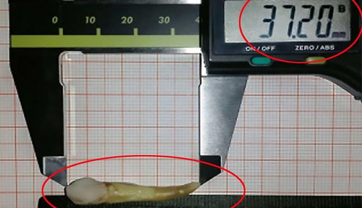 weird news in hindi,longest human tooth extracted,guinness world records