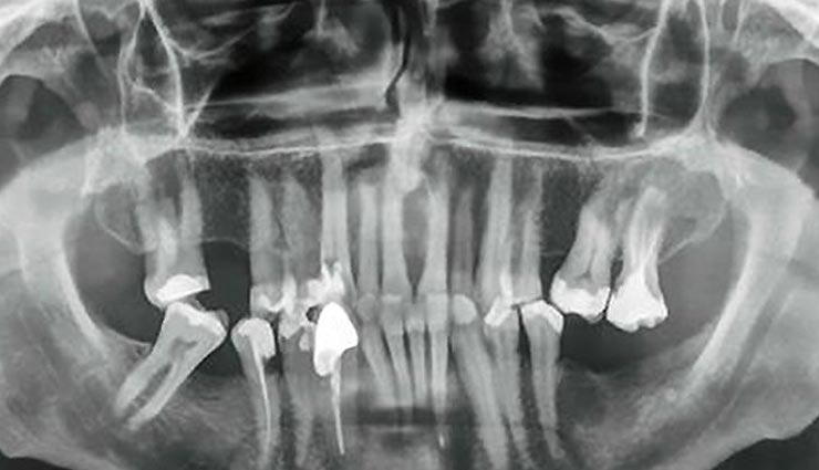 weird news in hindi,longest human tooth extracted,guinness world records