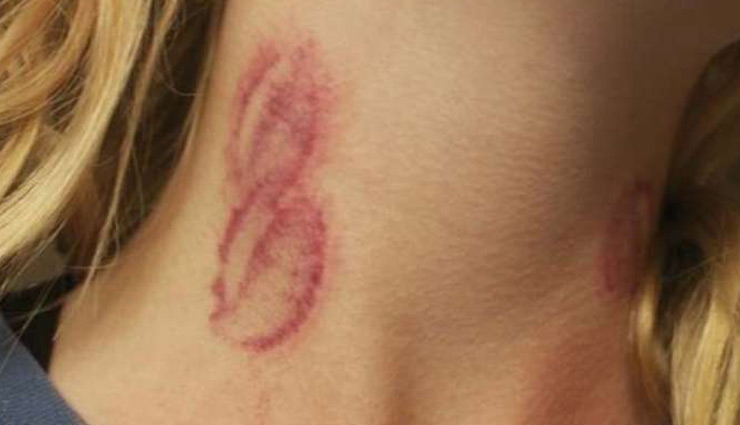 लव बाइट ना बन जाए कहीं शर्मिंदगी की वजह, ये ब्यूटी टिप्स आएंगे बहुत काम