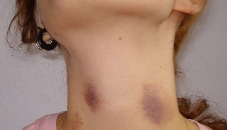 लव बाइट का निशान ना बन जाए शर्मिंदगी का कारण, मिनटों में करें गायब इन आसान ब्यूटी टिप्स की मदद से