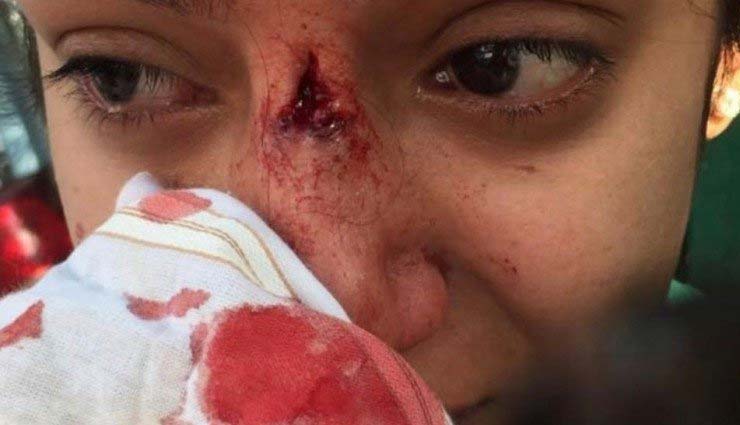 घर के आगे कुत्ता टहलाना पड़ा महंगा, डॉक्टर ने पत्थर मारकर लड़की की नाक तोड़ी