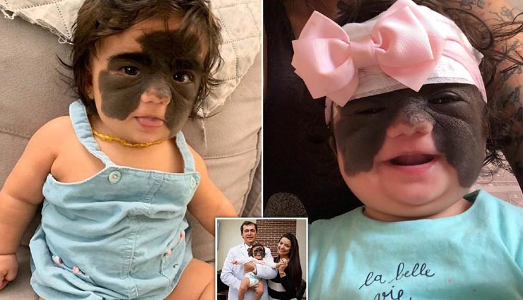 यहां पैदा हुई सुपरहीरो कही जाने वाली बच्ची, बना हुआ है 'बैटमैन मास्क' जैसा बर्थ मार्क