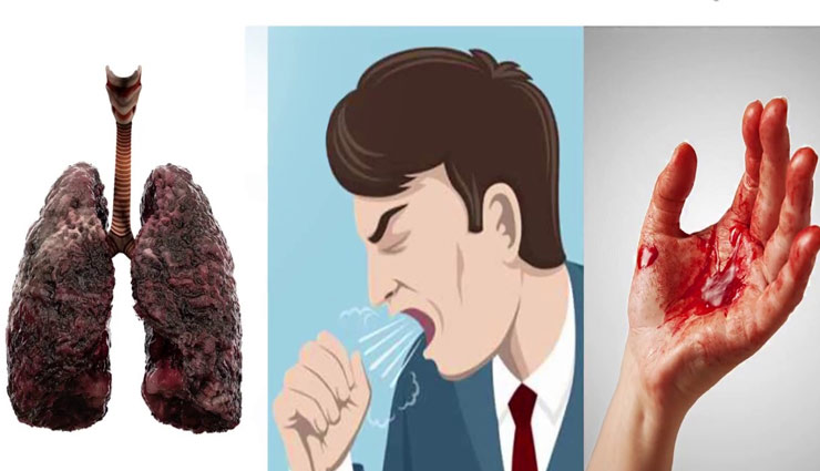 खांसते वक्त खून निकलना देता है फेफड़ों के कैंसर का संकेत, जानें इसके अन्य लक्षण 