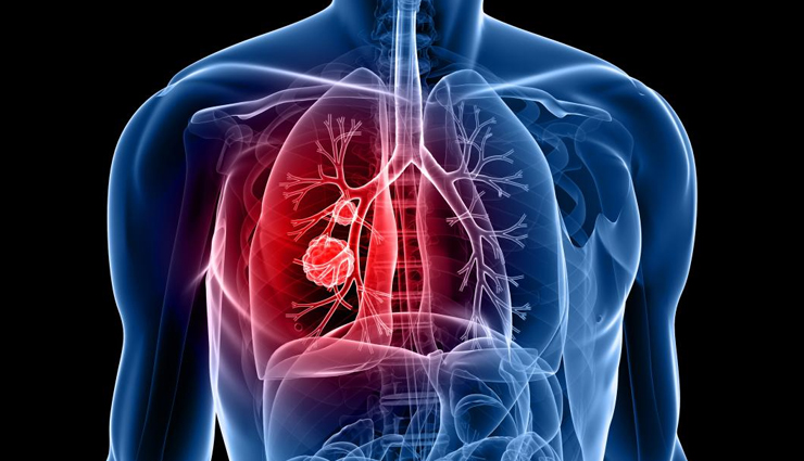 World Lung Cancer Day: 10 Bad Habits Responsible for Lung Cancer