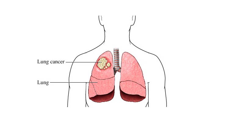 lung cancer,symptoms,lung cancer causes,lung cancer treatment,Health tips,healthy living