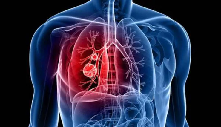 कोरोना संक्रमण से उबर चुके मरीजों के फेफड़े 100% नहीं कर पा रहे हैं काम