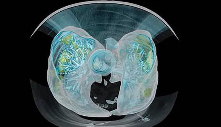 coronavirus,lungs,coronavirus lungs,Health
