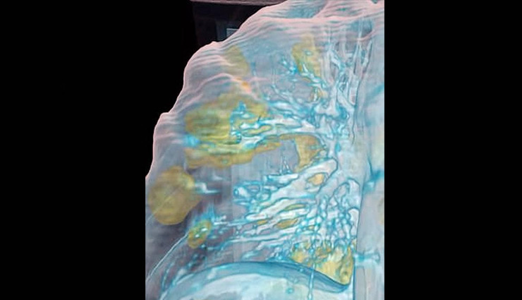 coronavirus,lungs,coronavirus lungs,Health