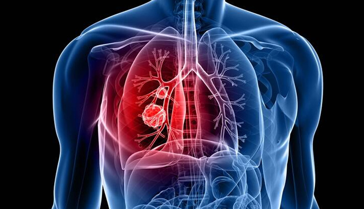 copd symptoms and causes,understanding copd: symptoms and reasons,causes and symptoms of copd,chronic obstructive pulmonary disease symptoms and causes,what is copd? symptoms and risk factors,copd: signs,symptoms,and causes,exploring copd: symptoms and underlying reasons,recognizing copd symptoms and risk factors,unraveling copd: understanding its symptoms and causes,symptoms and etiology of copd