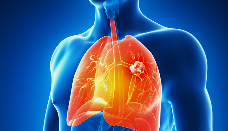 lungs,coronavirus,infection,corona infection,Health