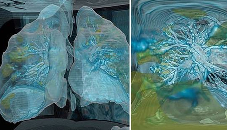 कोरोना वायरस कैसे कुछ ही दिनों में फेफड़ों को कर देता है बर्बाद, देखे तस्वीरें